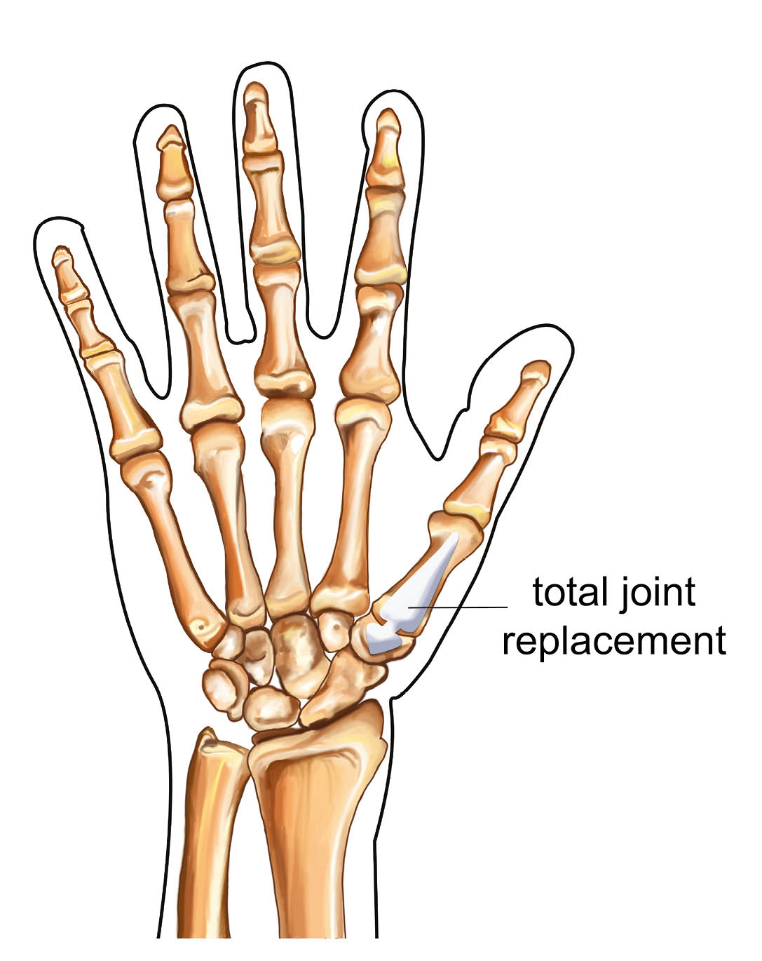 Diagram showing a total joint replacement (ball and socket type joint).