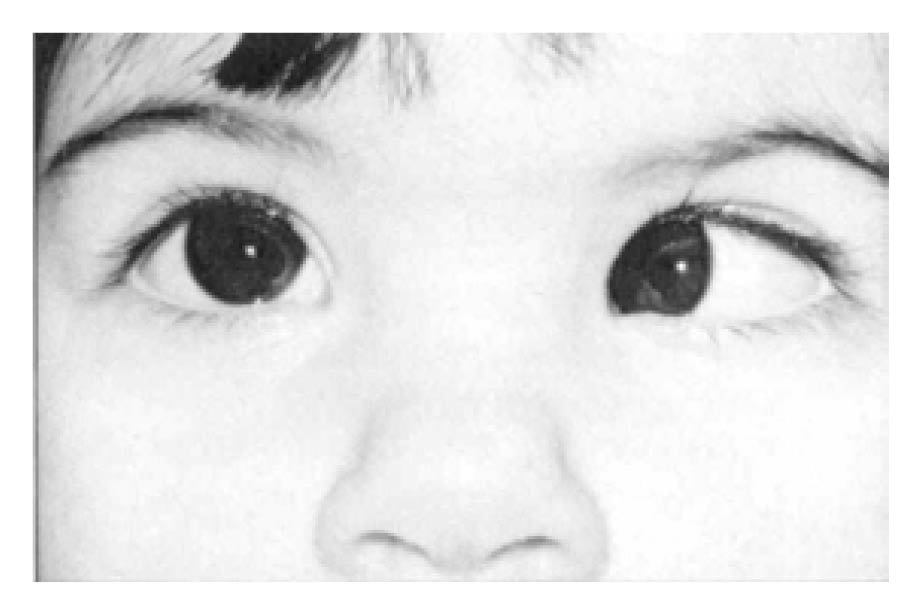 Photo showing a left convergent squint (the child's eye turns in)