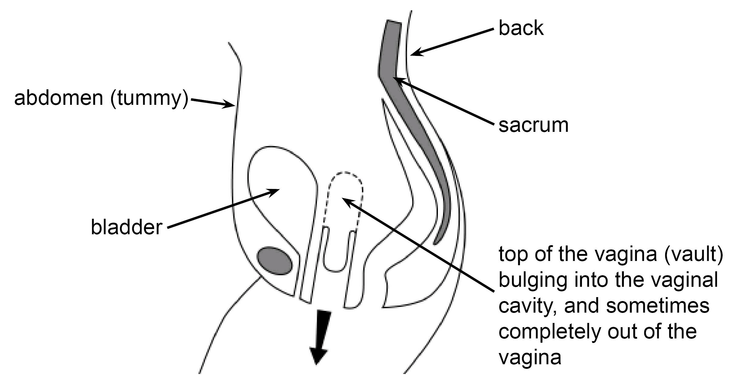 Diagram of a sideways view, showing the normal position of a vagina (dotted line) and a prolapsing vaginal vault (continuous line)