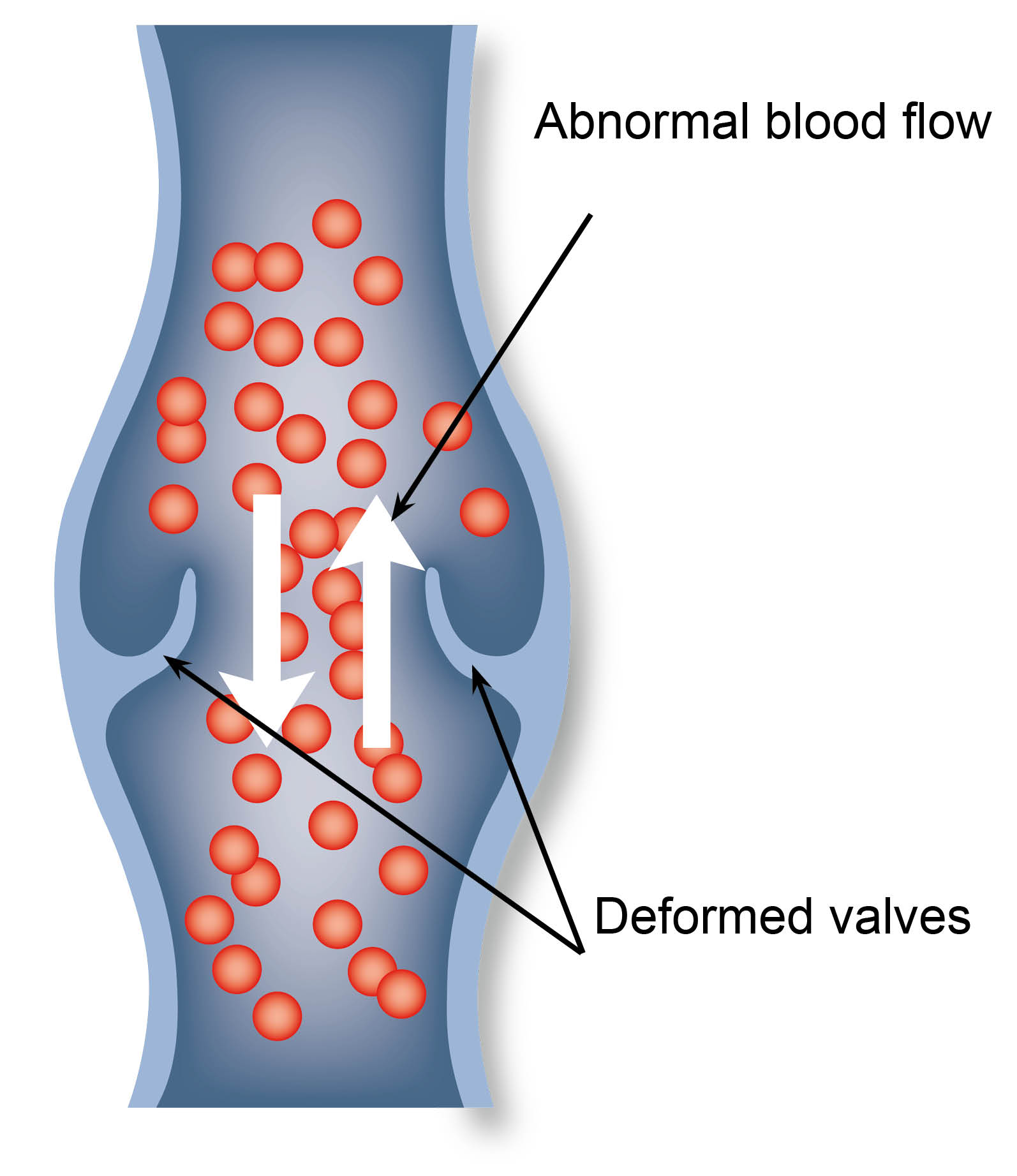 varicose-vein-abnormal-blood-flow.jpg