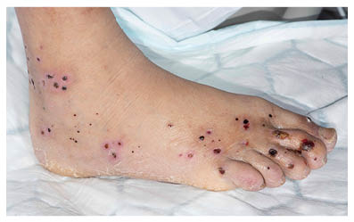 Foot with a typical appearance of rash in AASV.