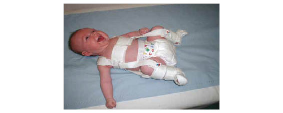 Photo of a baby wearing a Pavlik Harness, with their hips and knees bent in a 'frog' position