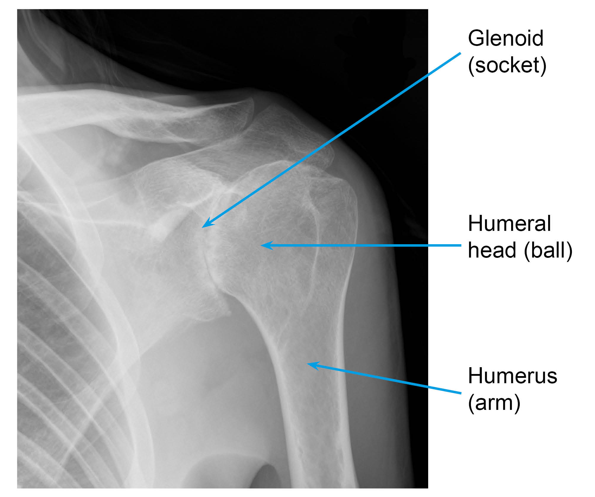 X-ray showing a shoulder with osteoarthritis: decreased joint space and bone growth around the edges of the joint due to wear and tear