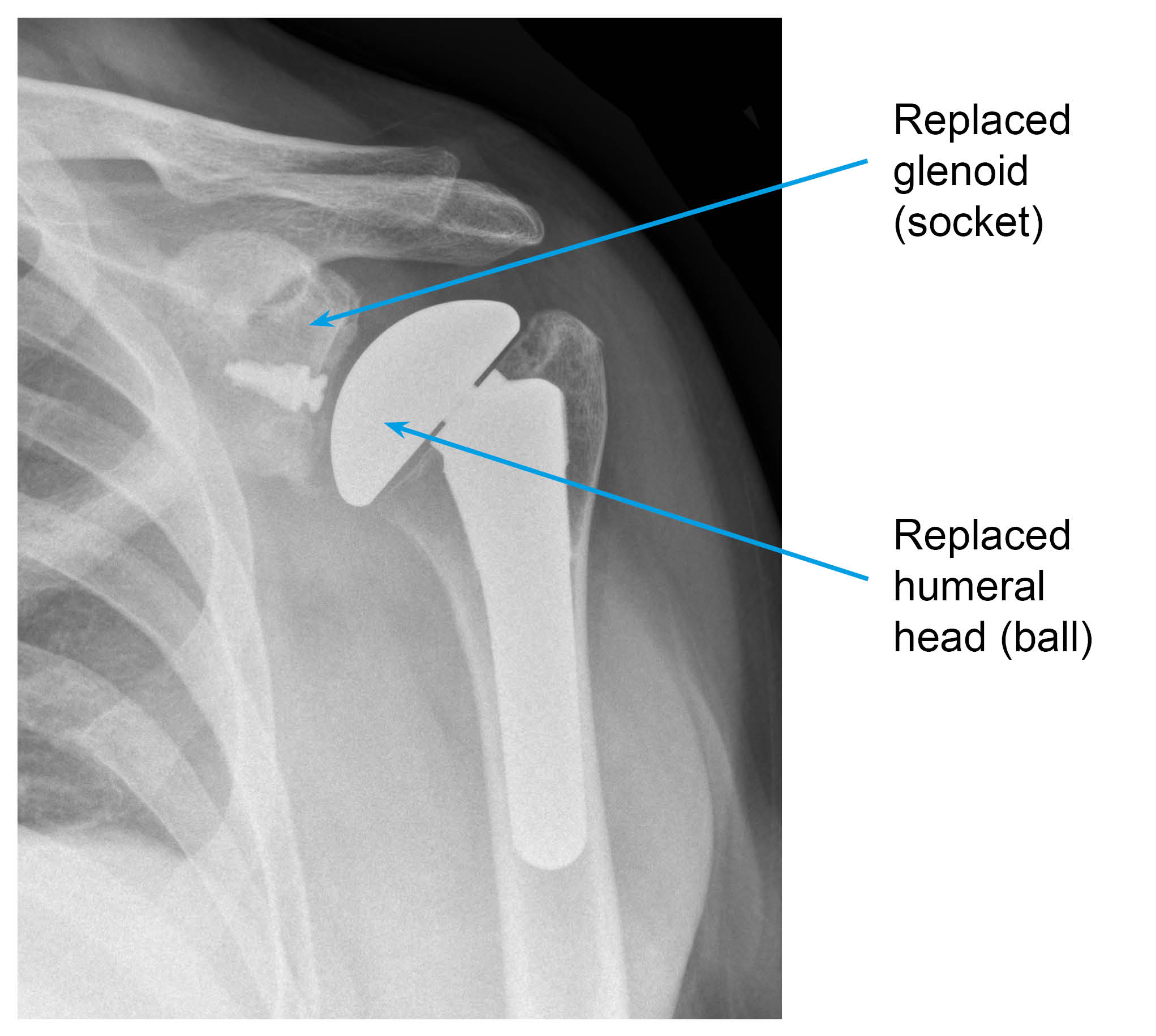 X-ray showing the “ball” has been replaced with a metal head (long stem, short stem, or stemless) and the “socket” with a plastic or a metal and plastic piece mixture.