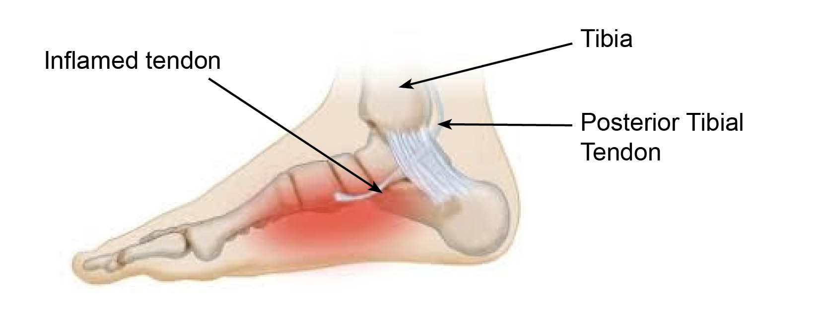 An inflamed tendon in your foot