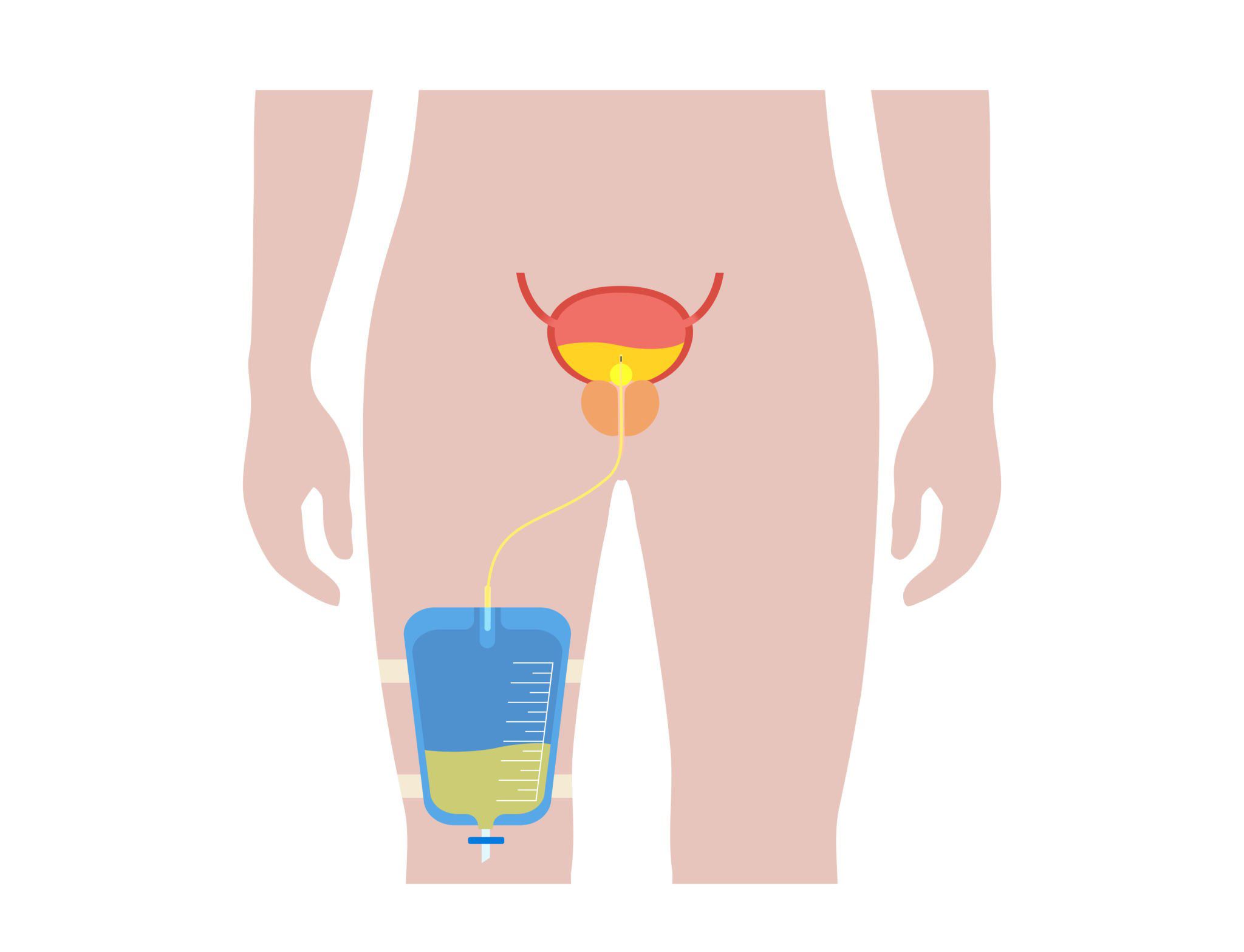 istock-urinary-drainage-bag-illustration.jpg