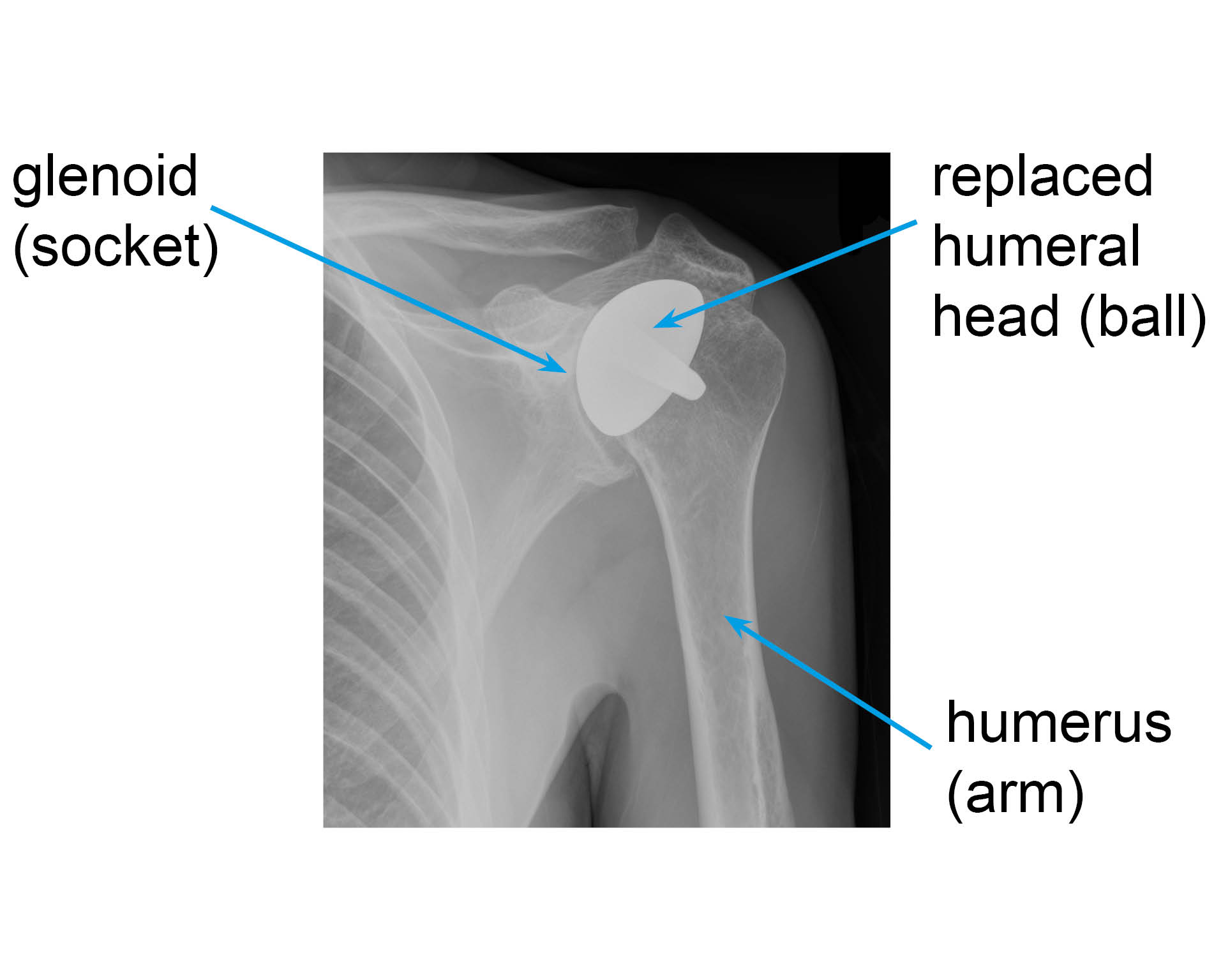 X-ray showing a shoulder with joint resurfacing, the ball has been replaced