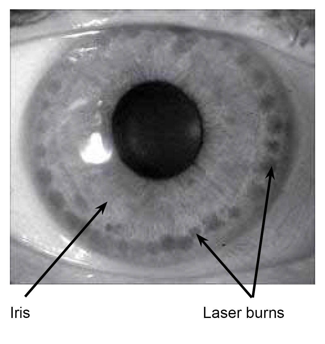 Laser burns all around the outside of the iris, seen as small dots