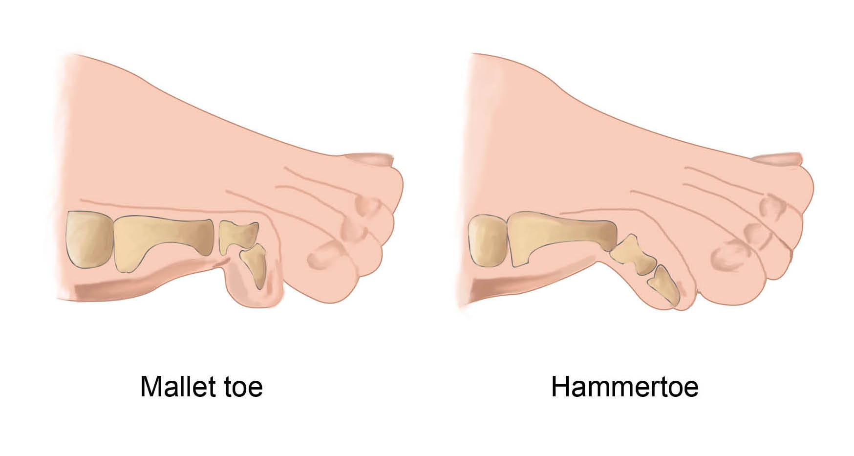 First diagram showing the small toe bent at the joint near the tip of the toe, called a mallet toe. The second diagram shows hammertoe, where the small toe is bent at the joint closest to the ball of the foot.