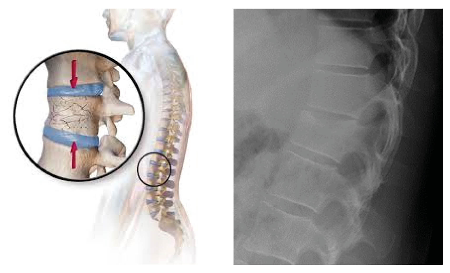 Images showing a mild wedge fracture or a lumbar vertebral body