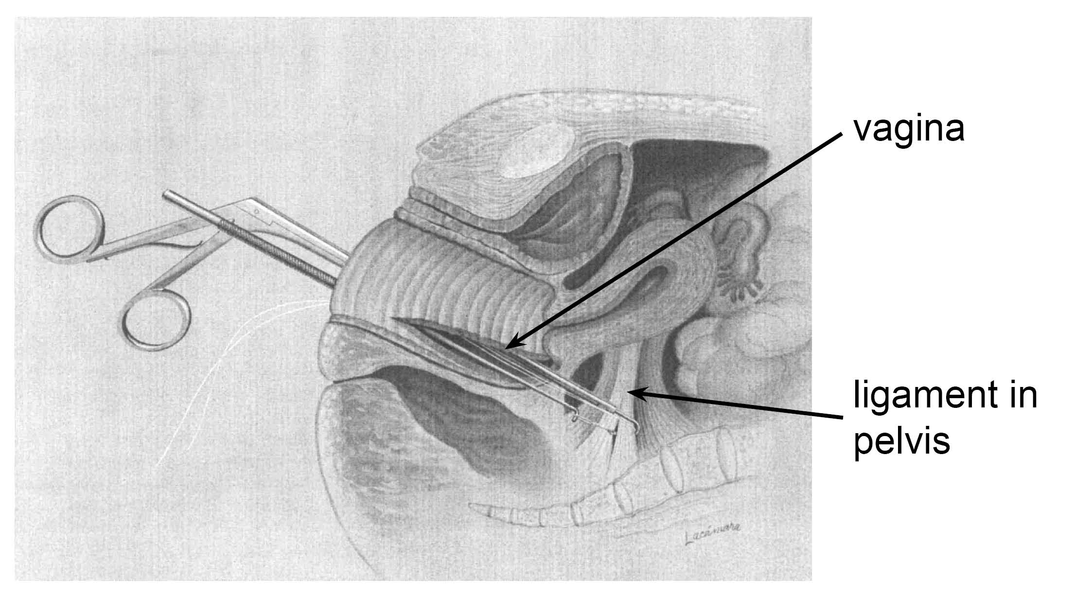 Diagram showing sacrospinous fixation using special instruments (Miya hook) done through the vagina