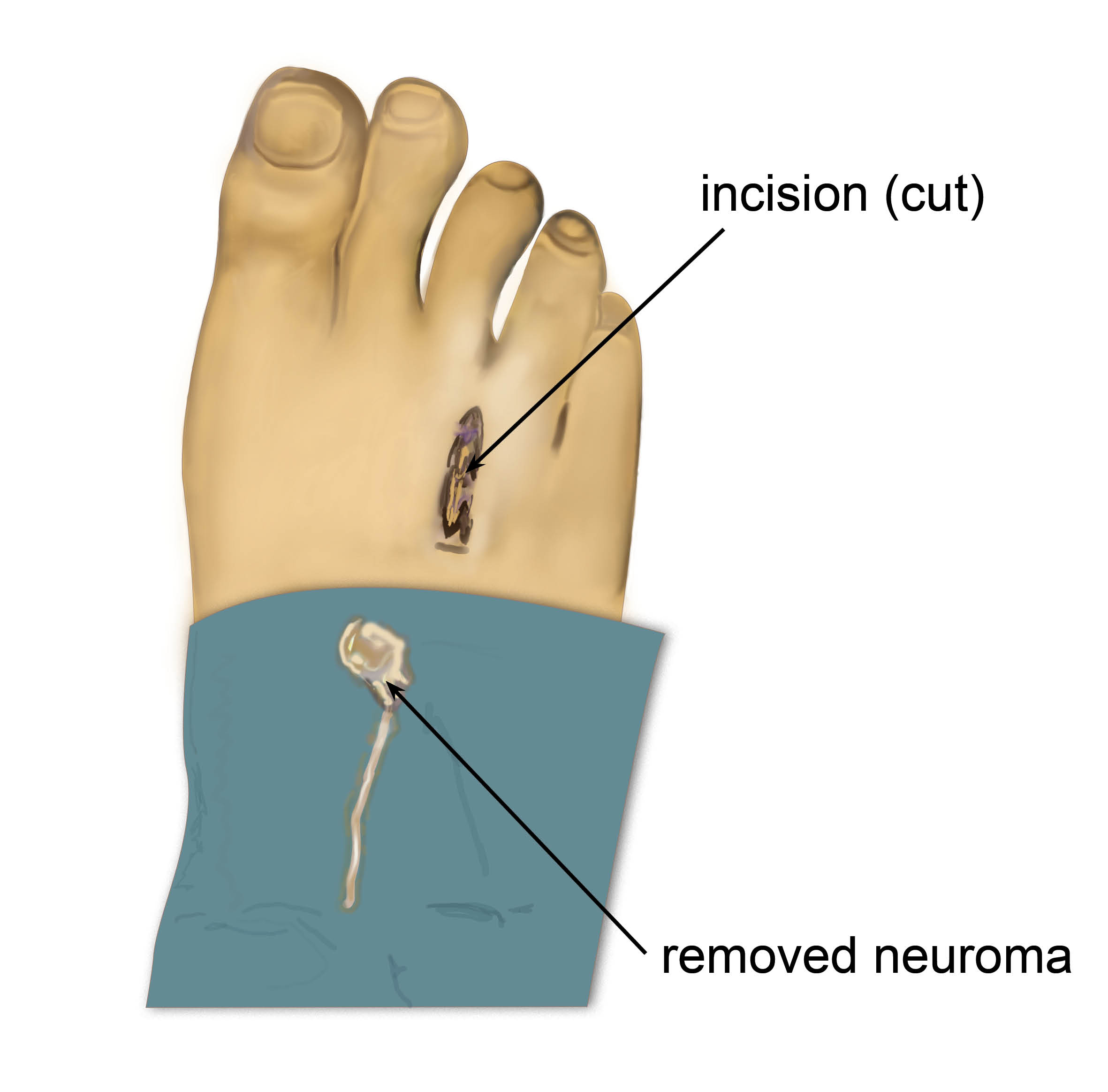 Diagram showing an incision (cut) on the top of the foot, and a removed neuroma