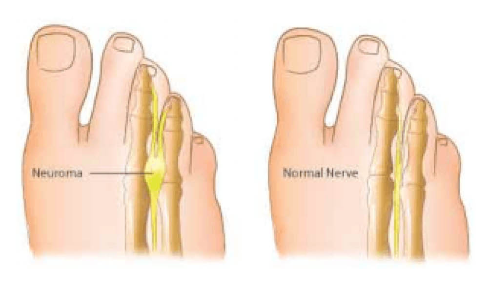 A diagram showing a normal nerve and an inflamed nerve (neuroma)