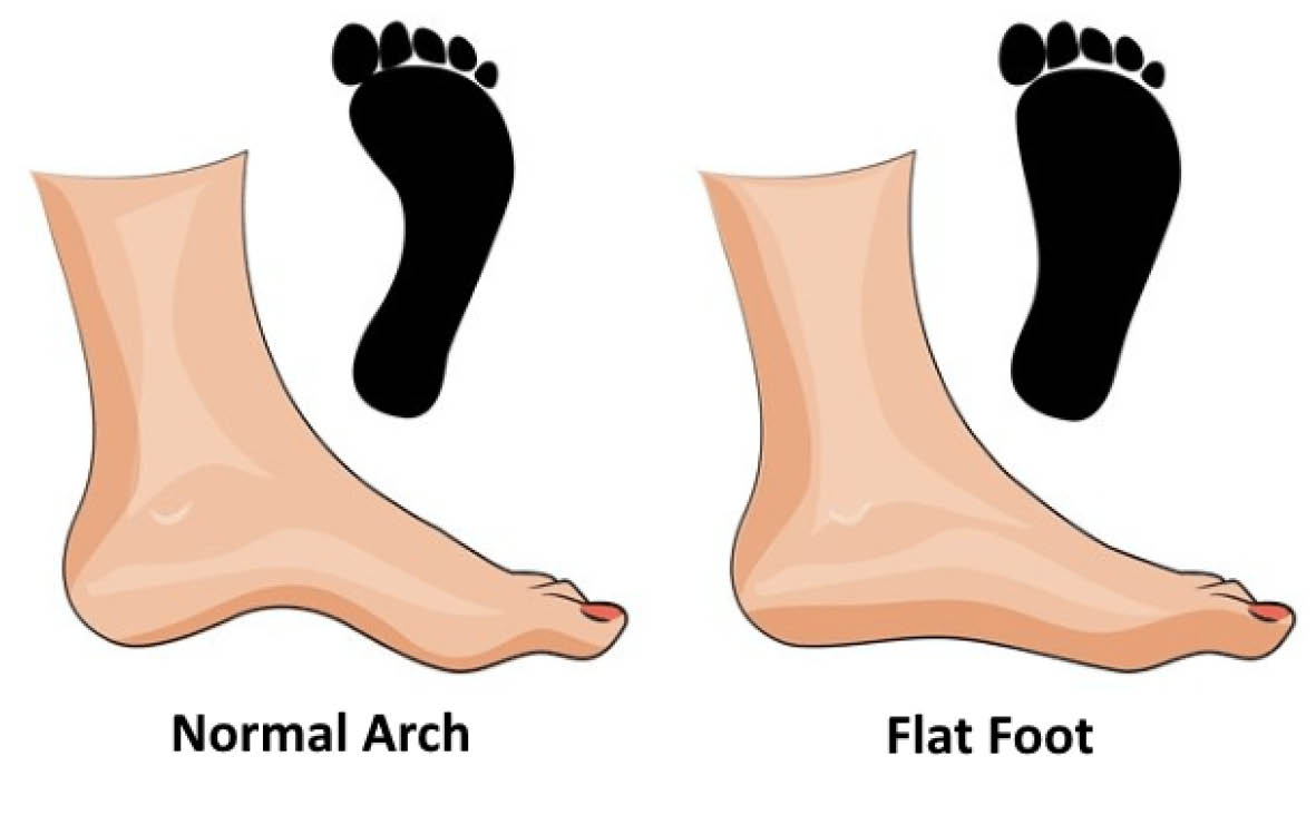 A normal arch and a flat arch