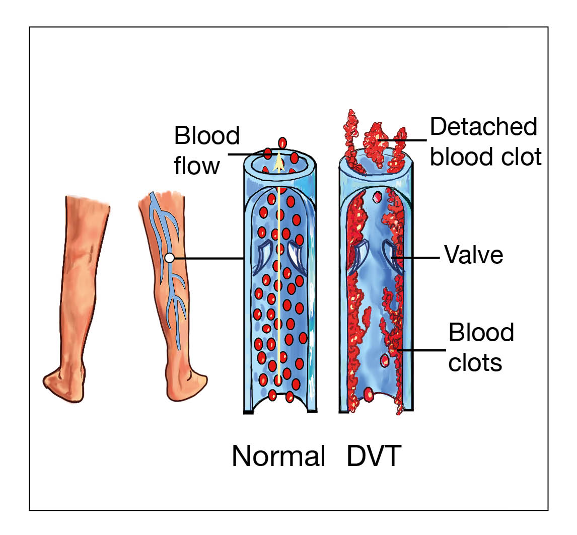 normal-vein-and-dvt-with-labels.jpg