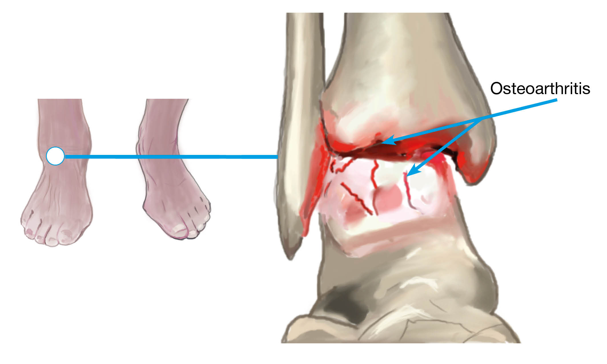 The joints of the ankle red and inflamed with osteoarthritis.