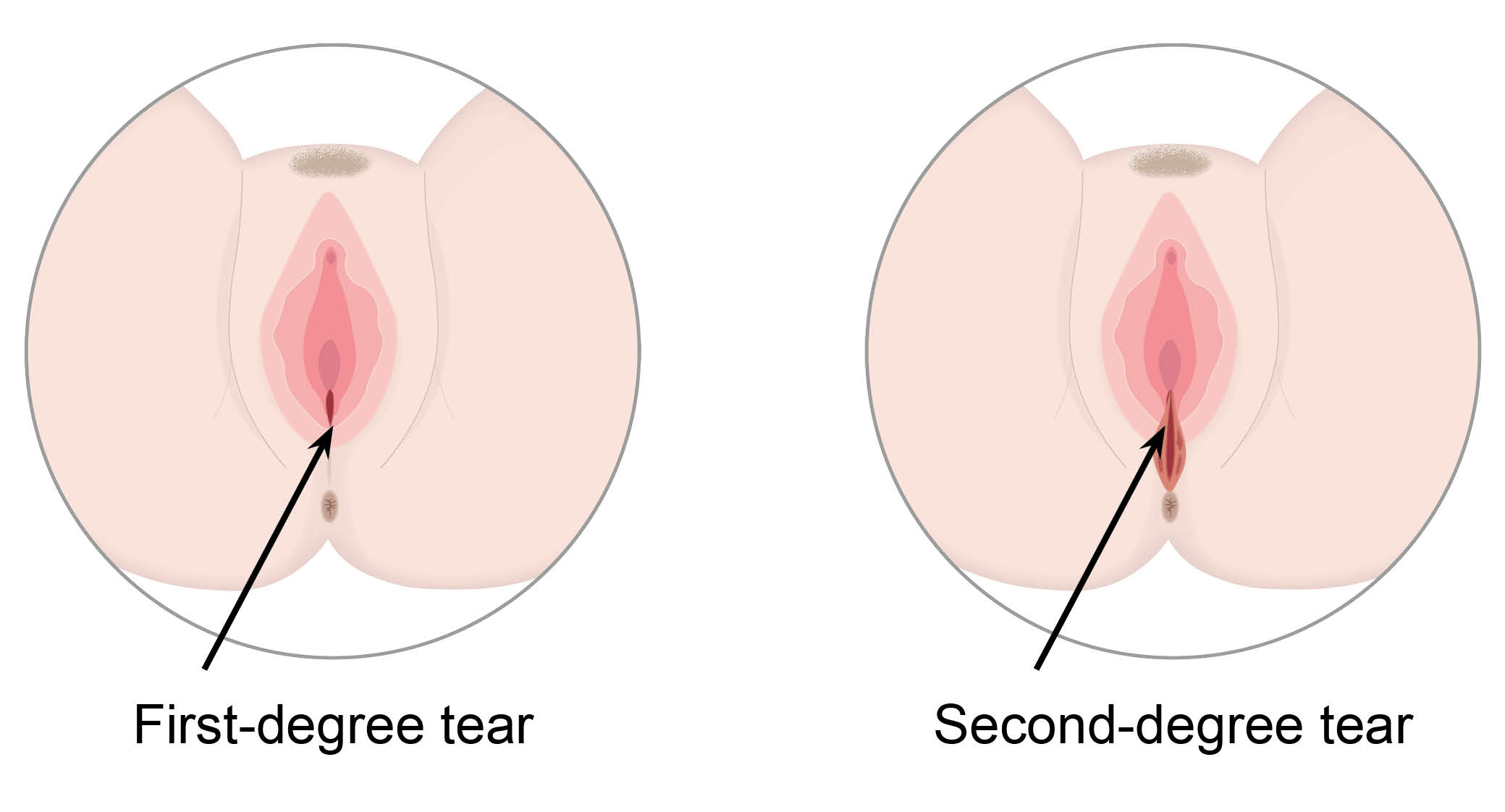 First degree tear is small and starts by the vaginal opening. The 2nd degree tear is in the same place but slightly larger.