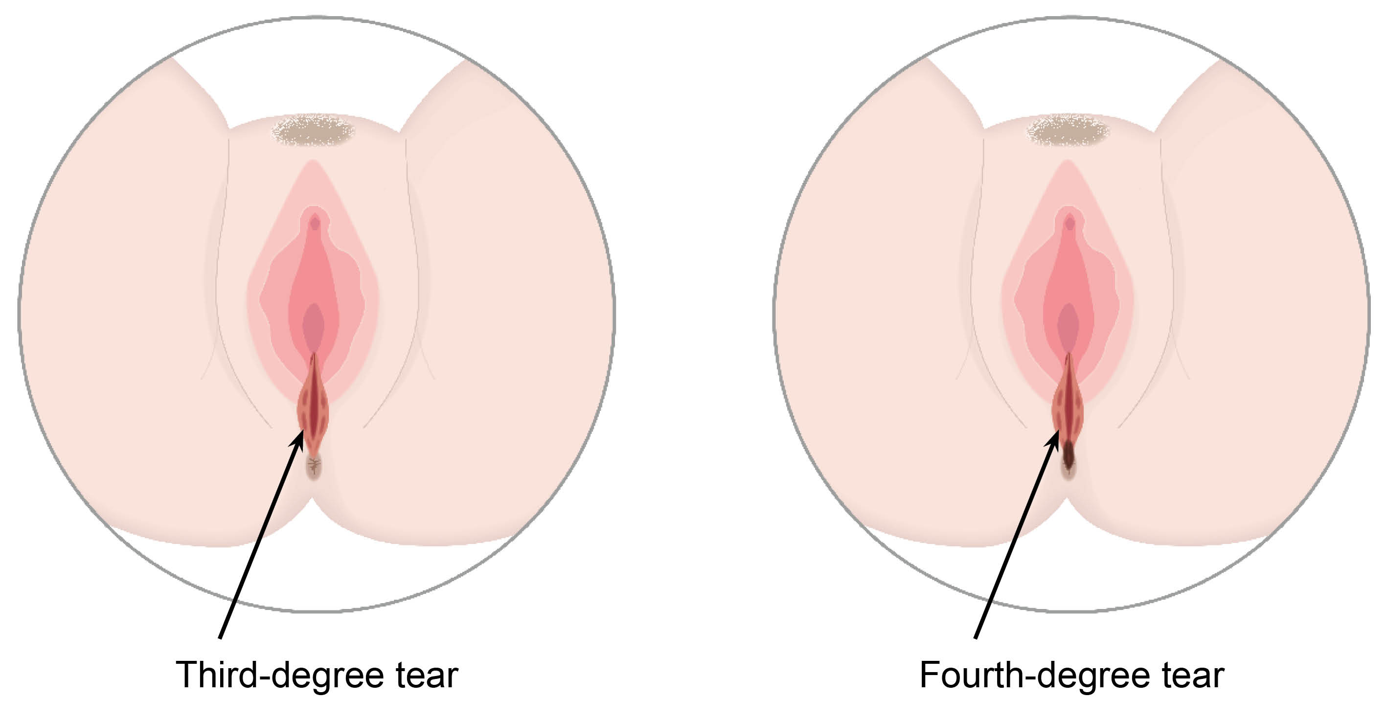 Third degree tear starting at the vaginal opening and going down to the anus. The 4th degree tear is in the same place but reaches the anal opening.