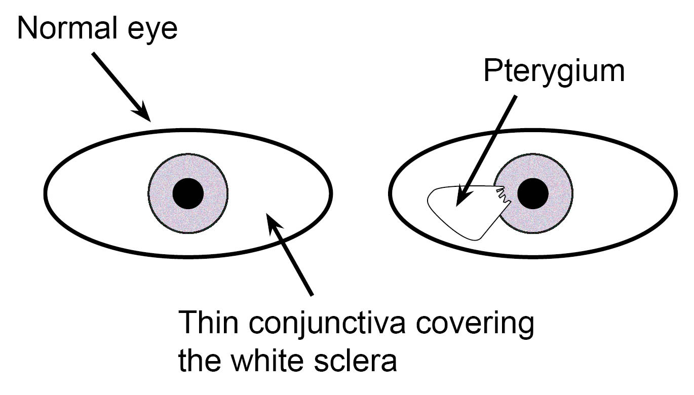 Normal eye, and an eye with pterygium on the surface