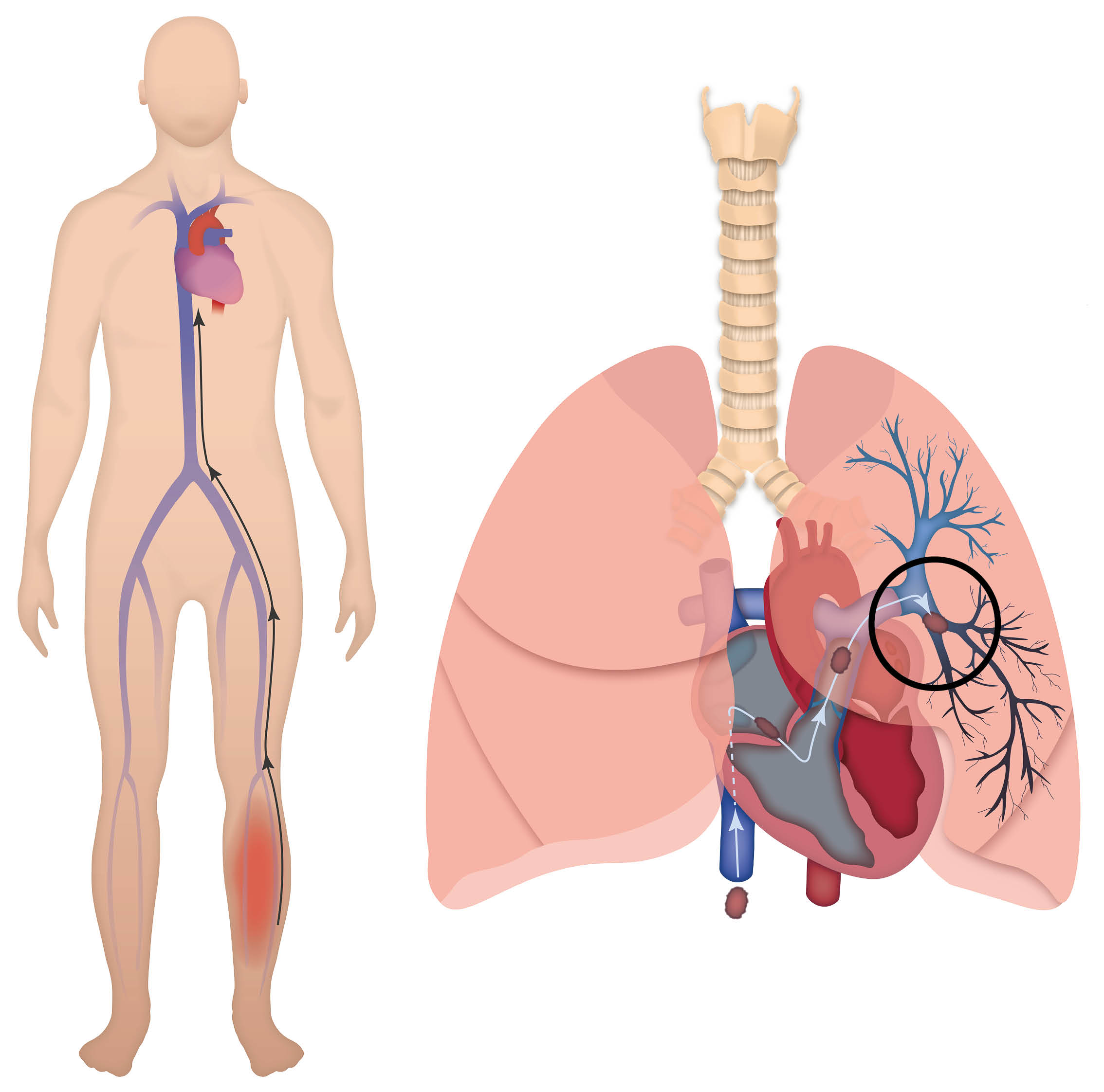 Diagram showing a blood clot in the lung