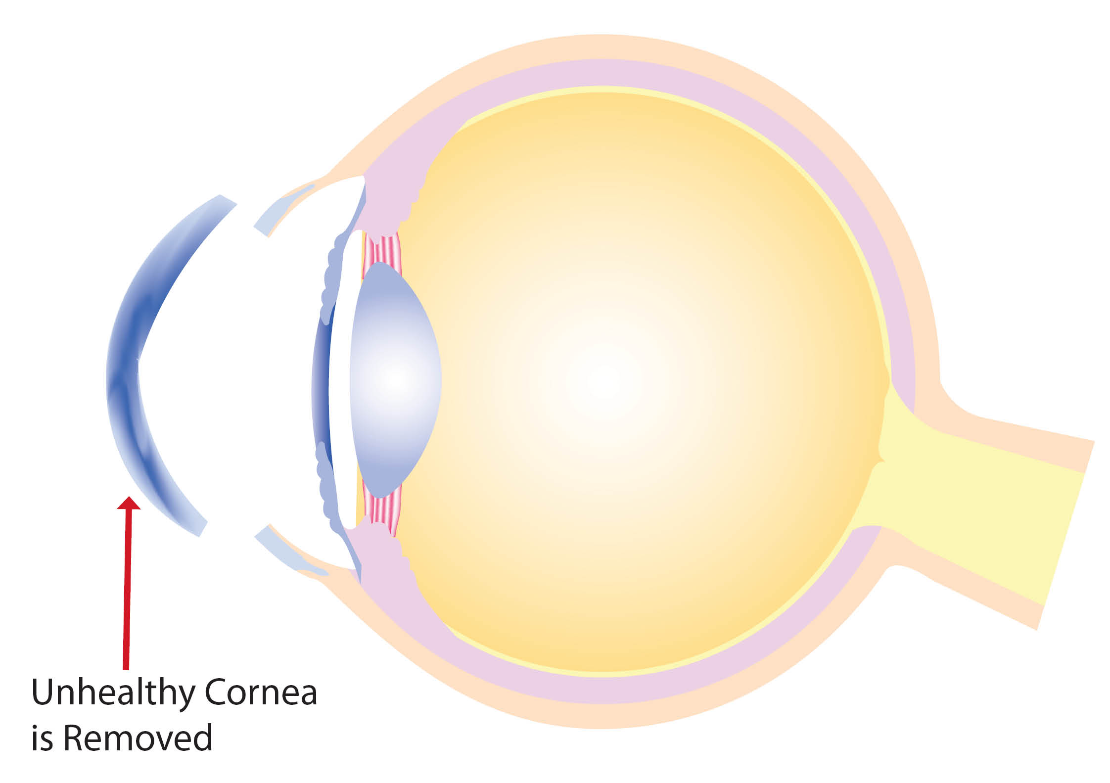 removal-of-unhealthy-cornea.jpg