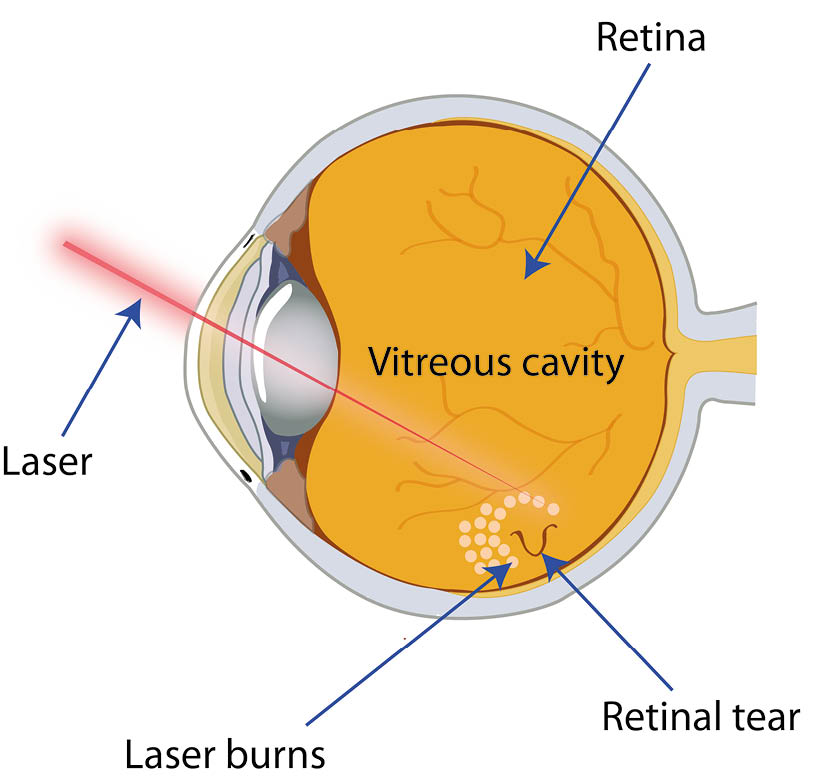 Diagram showing the laser, and the resulting laser burns on the eye