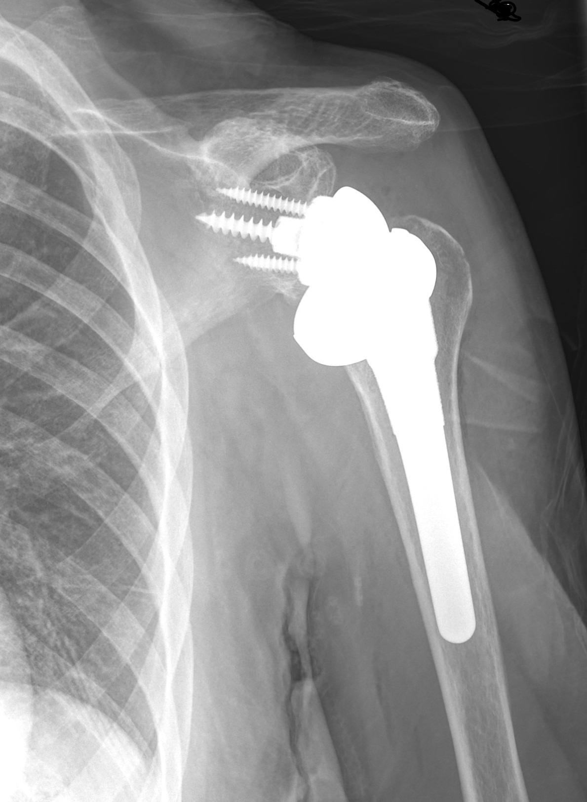 X-ray showing a reverse total shoulder replacement