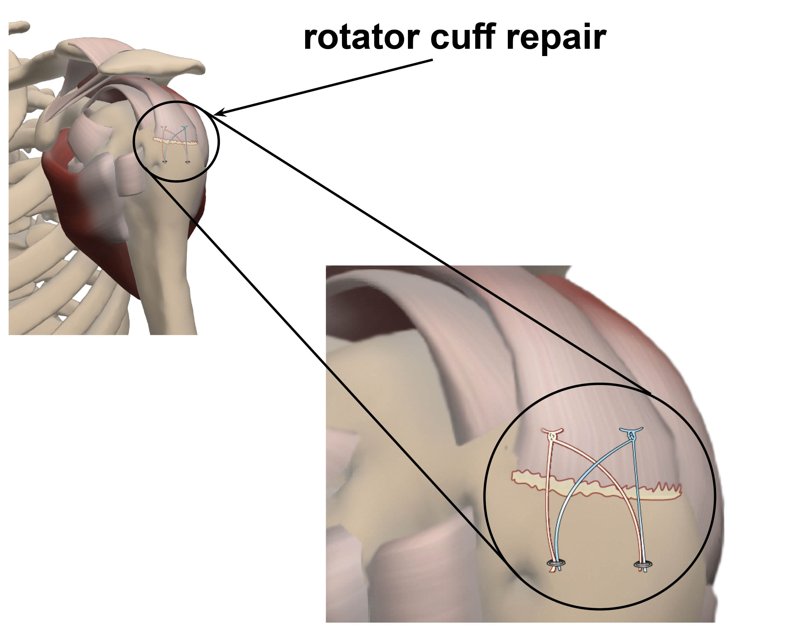 Diagram showing a rotator cuff repair