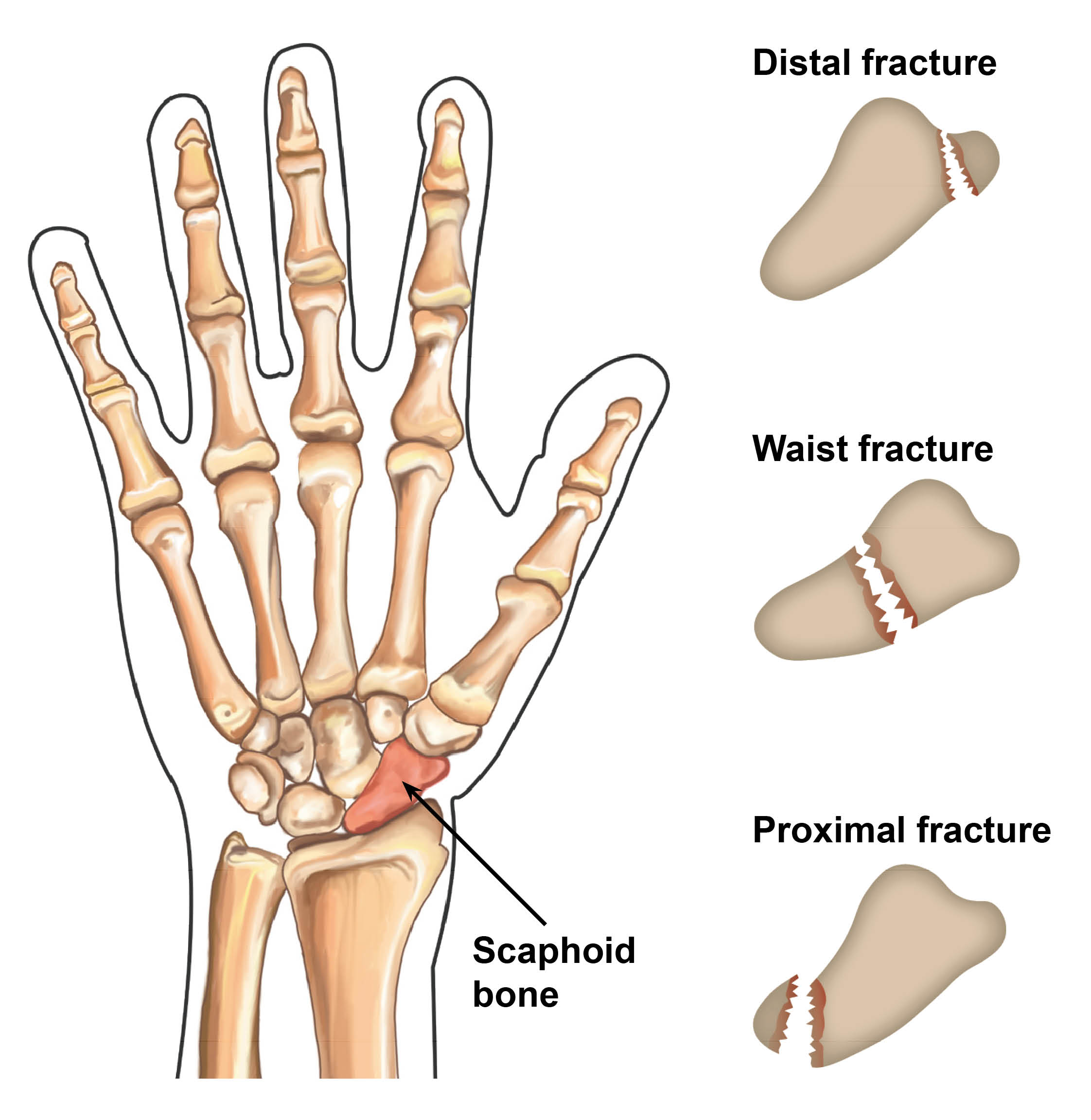 scaphoid-fractures-labelled.jpg