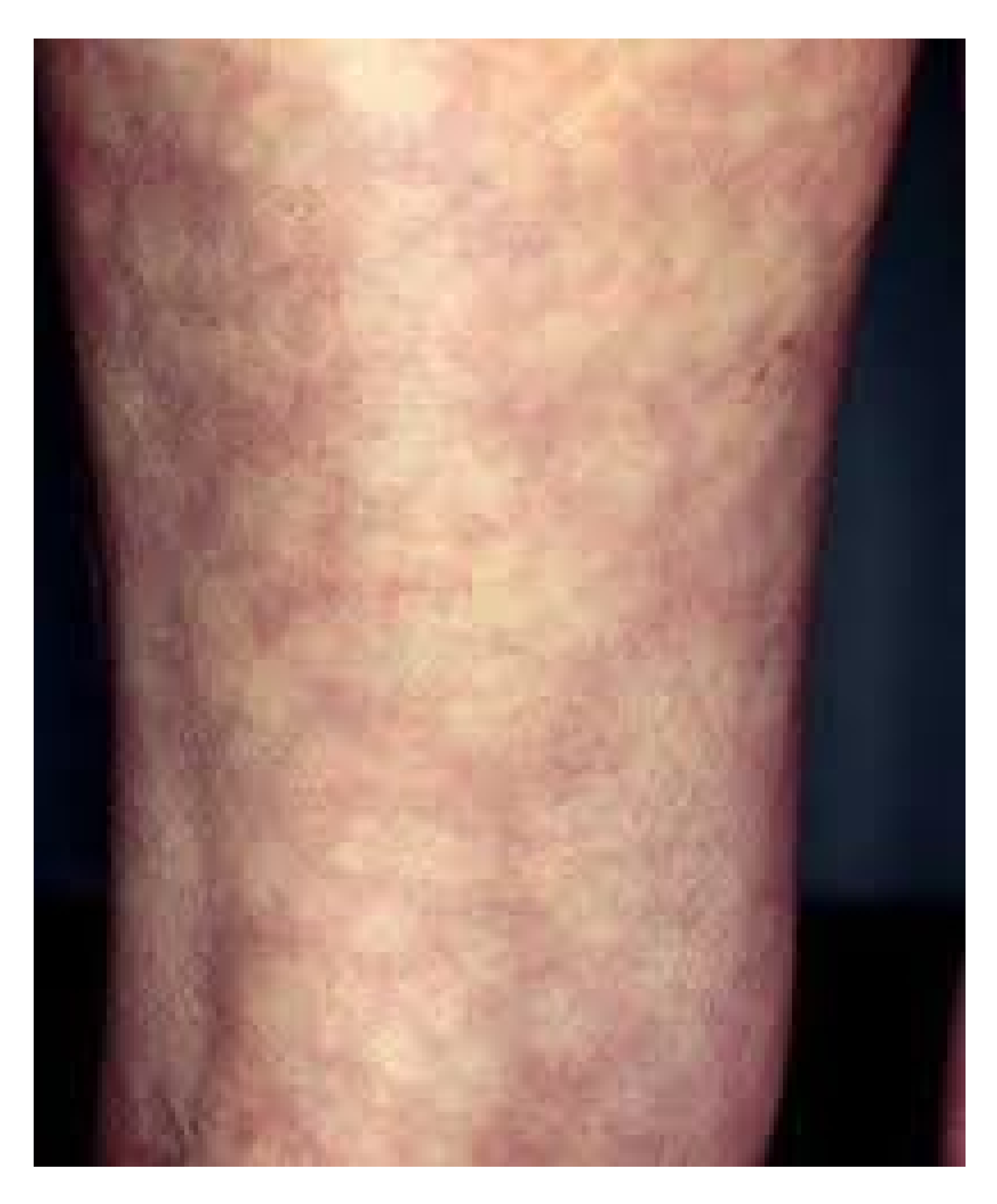 sepsis-mottled-skin-(2).jpg