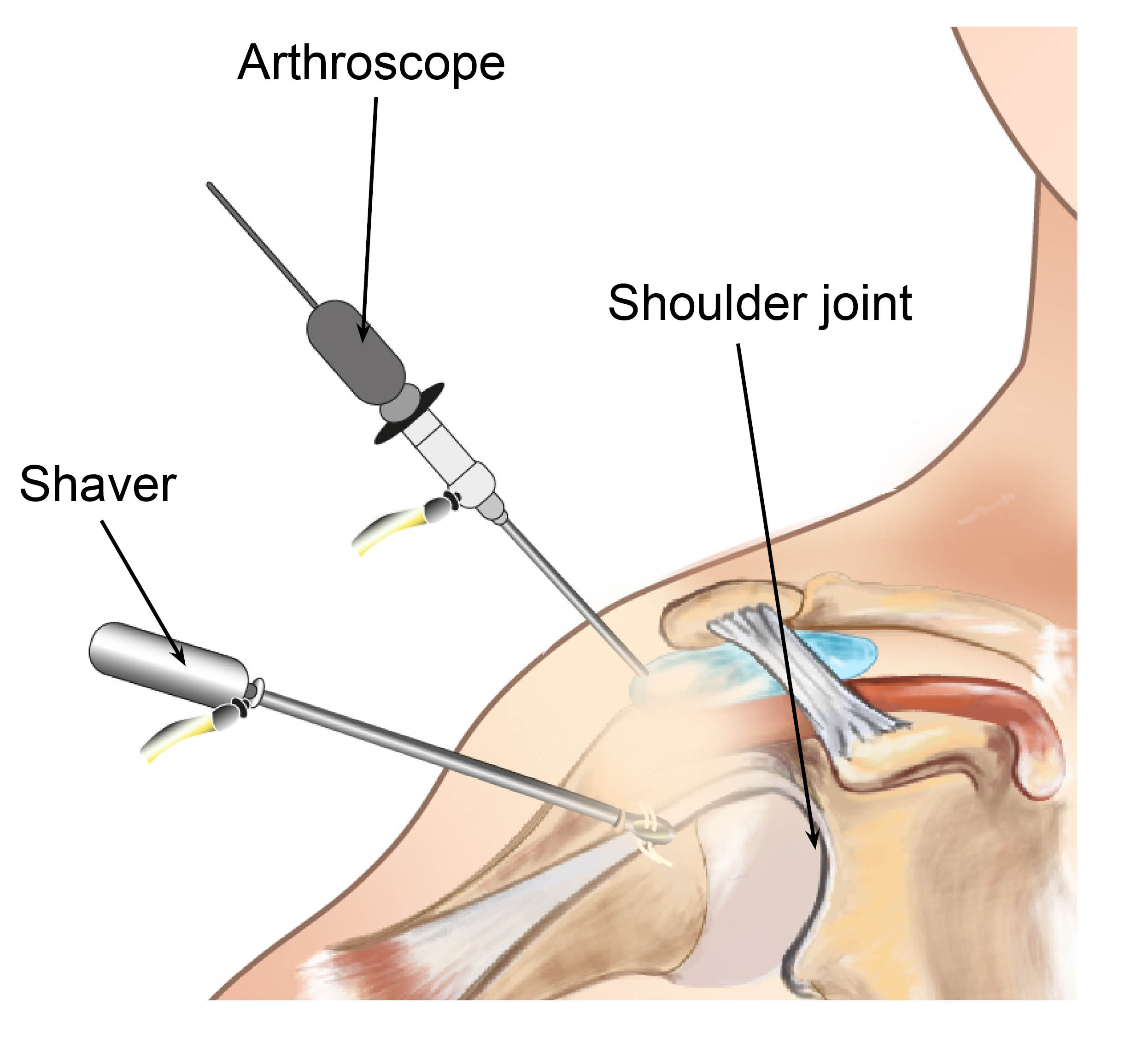 A shoulder arthroscopy