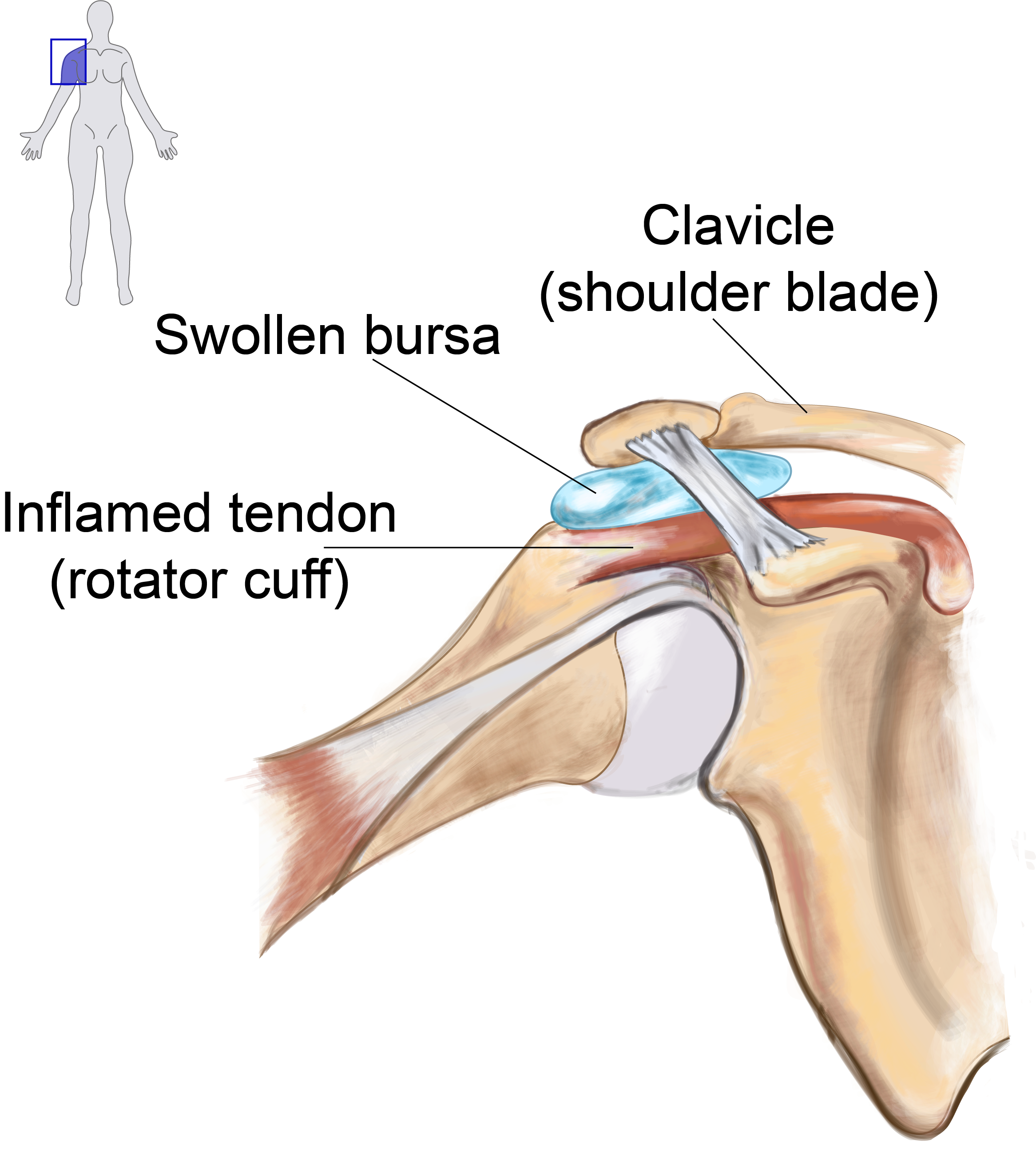 Structures in the shoulder with swollen bursa and inflamed tendon