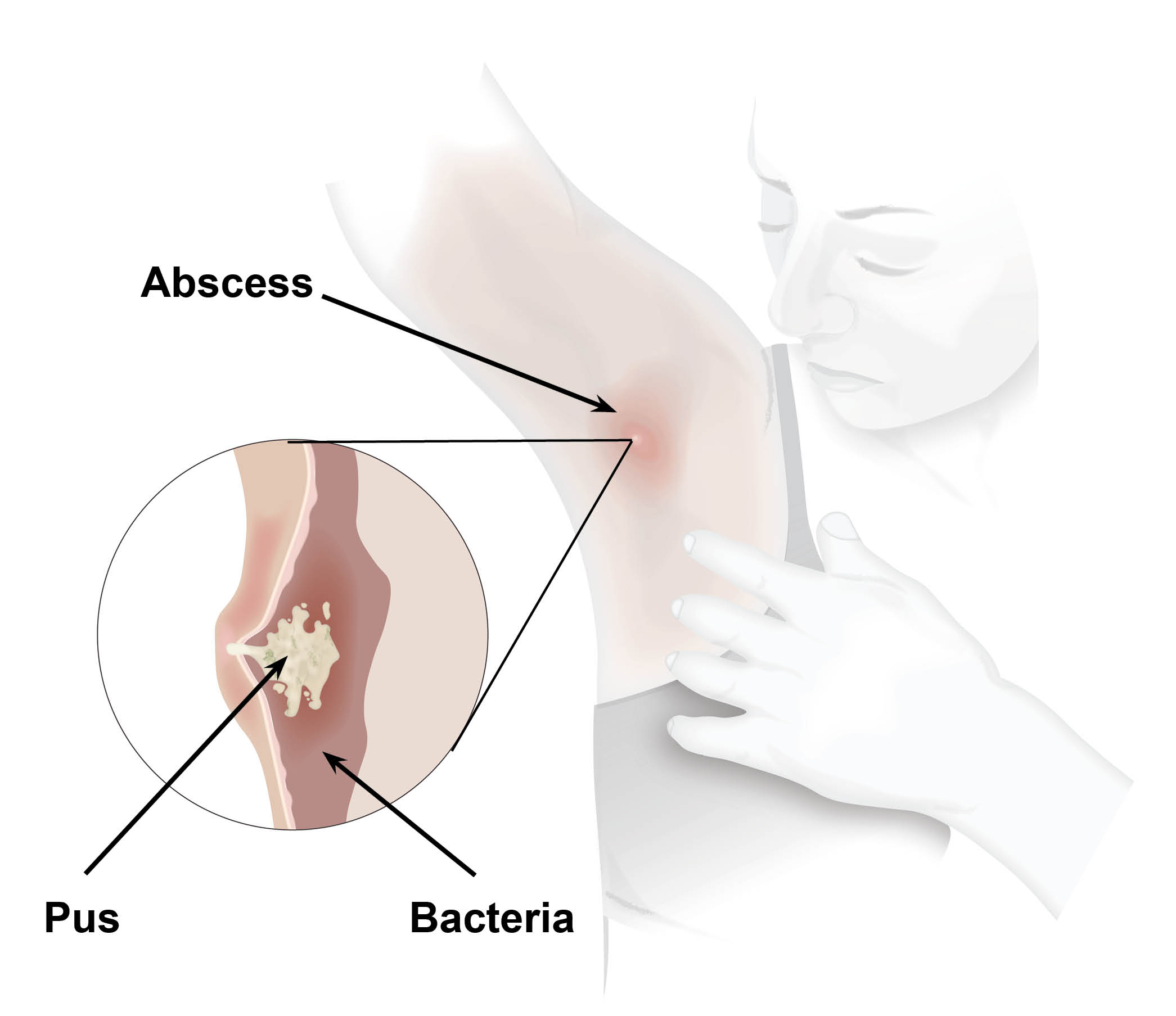 A skin abscess in an armpit