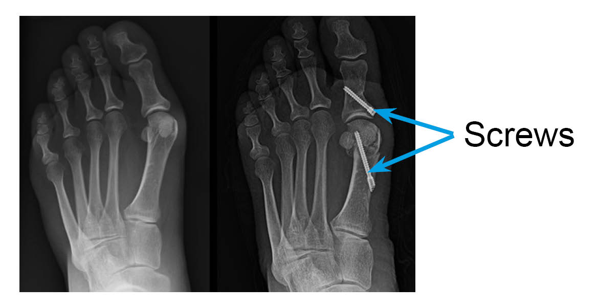 An x-ray showing two small screws holding the broken long bone of the big toe.