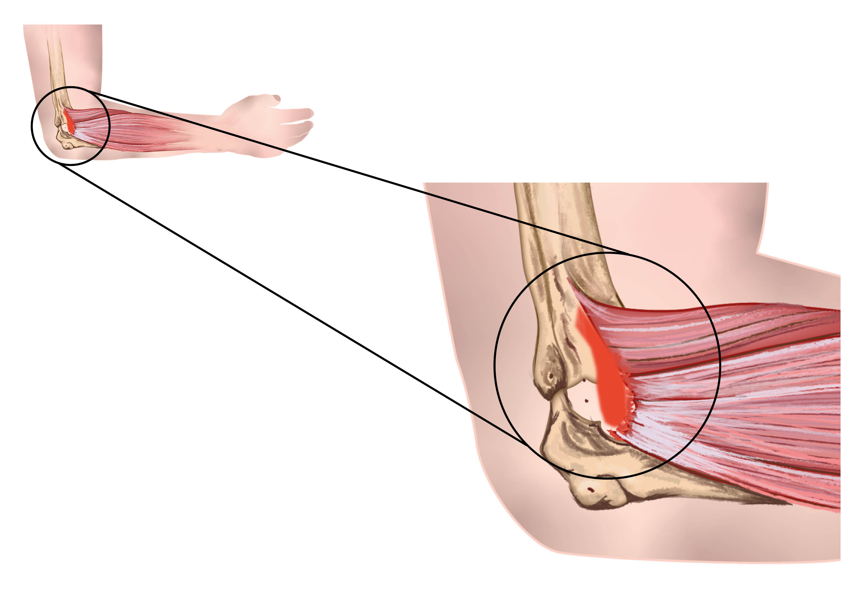 Diagram showing a blown up section of the elbow joint - showing the thickened and sore muscles and tendons in the forearm