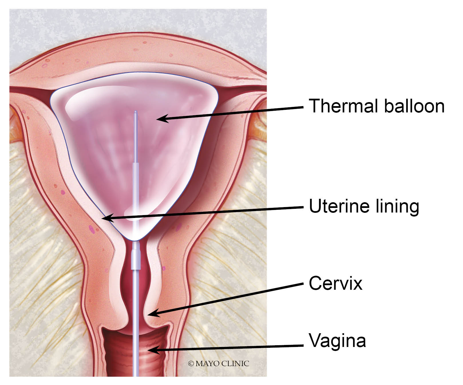 thermablate-uterine-balloon-system.jpg