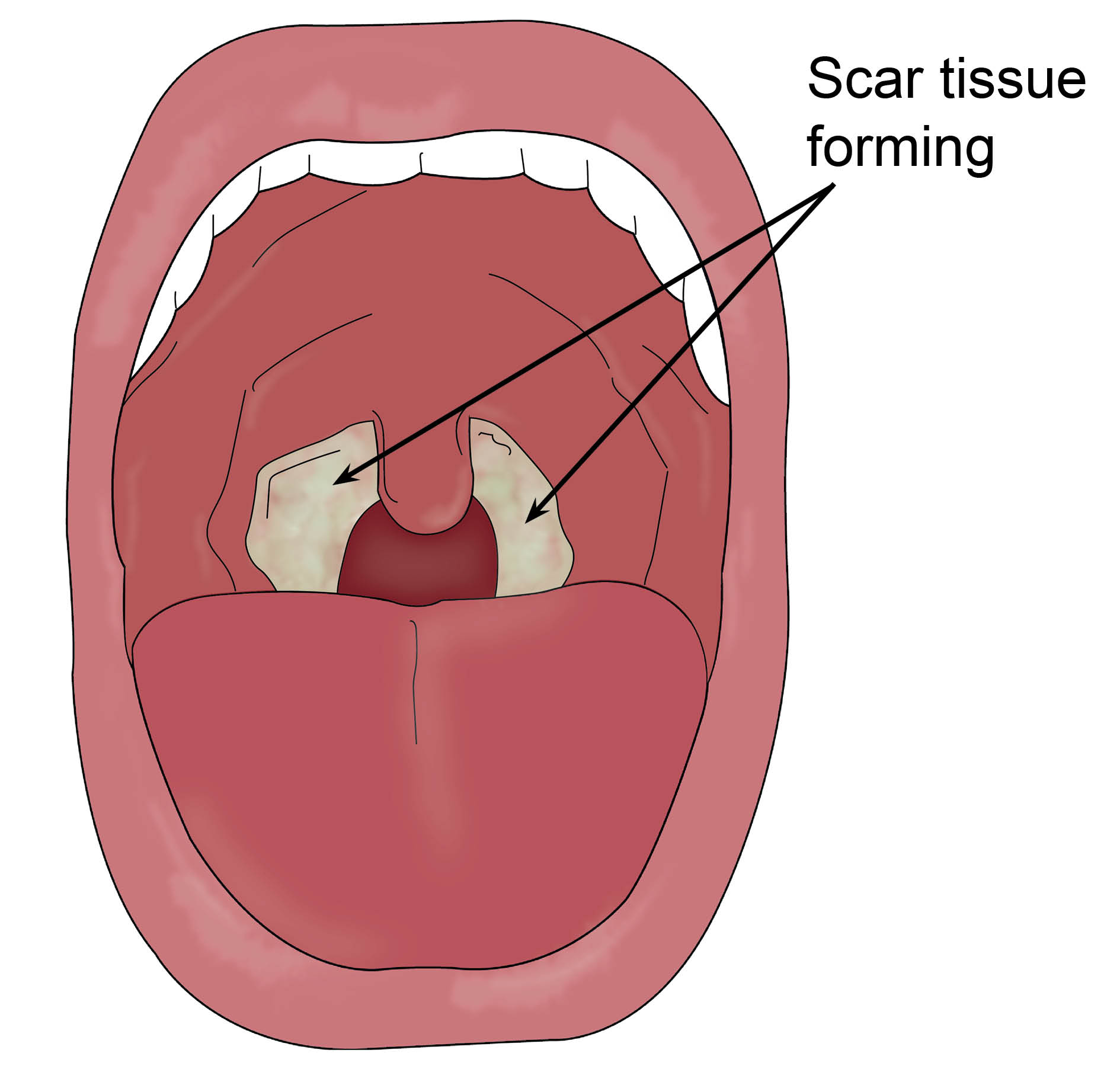 tonsil-post-op-with-labels.jpg