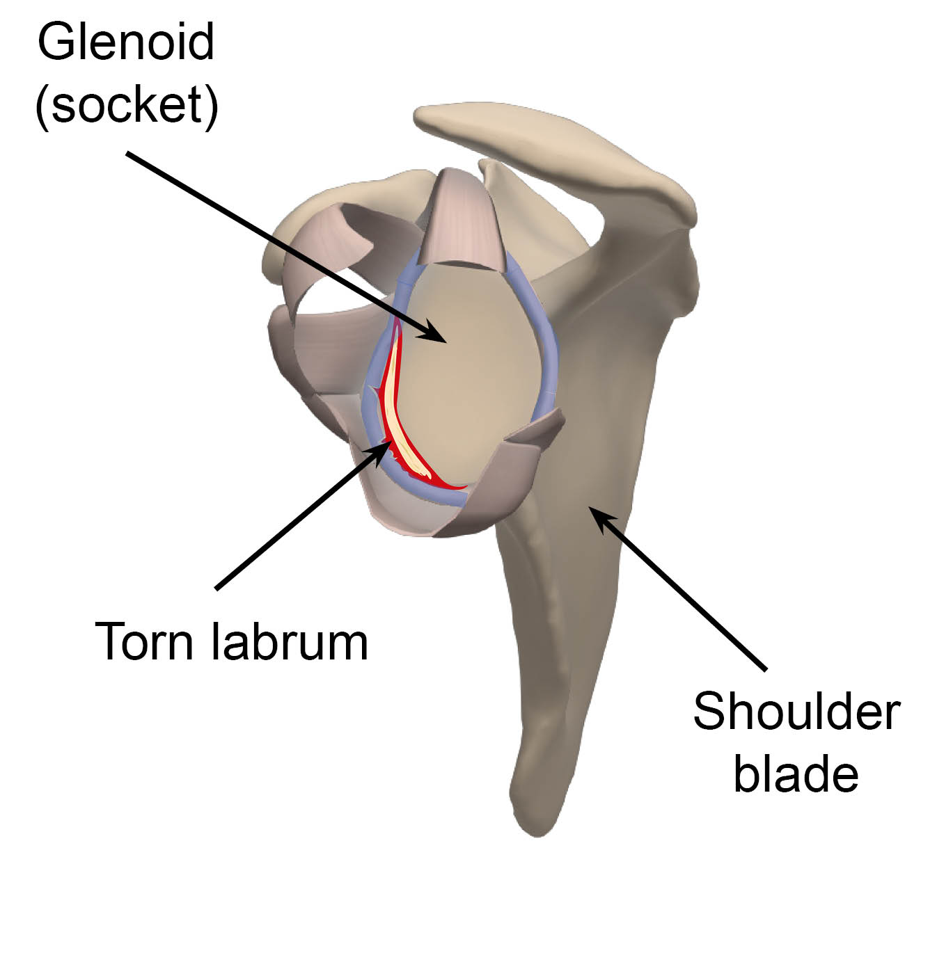 Diagram showing a torn labrum