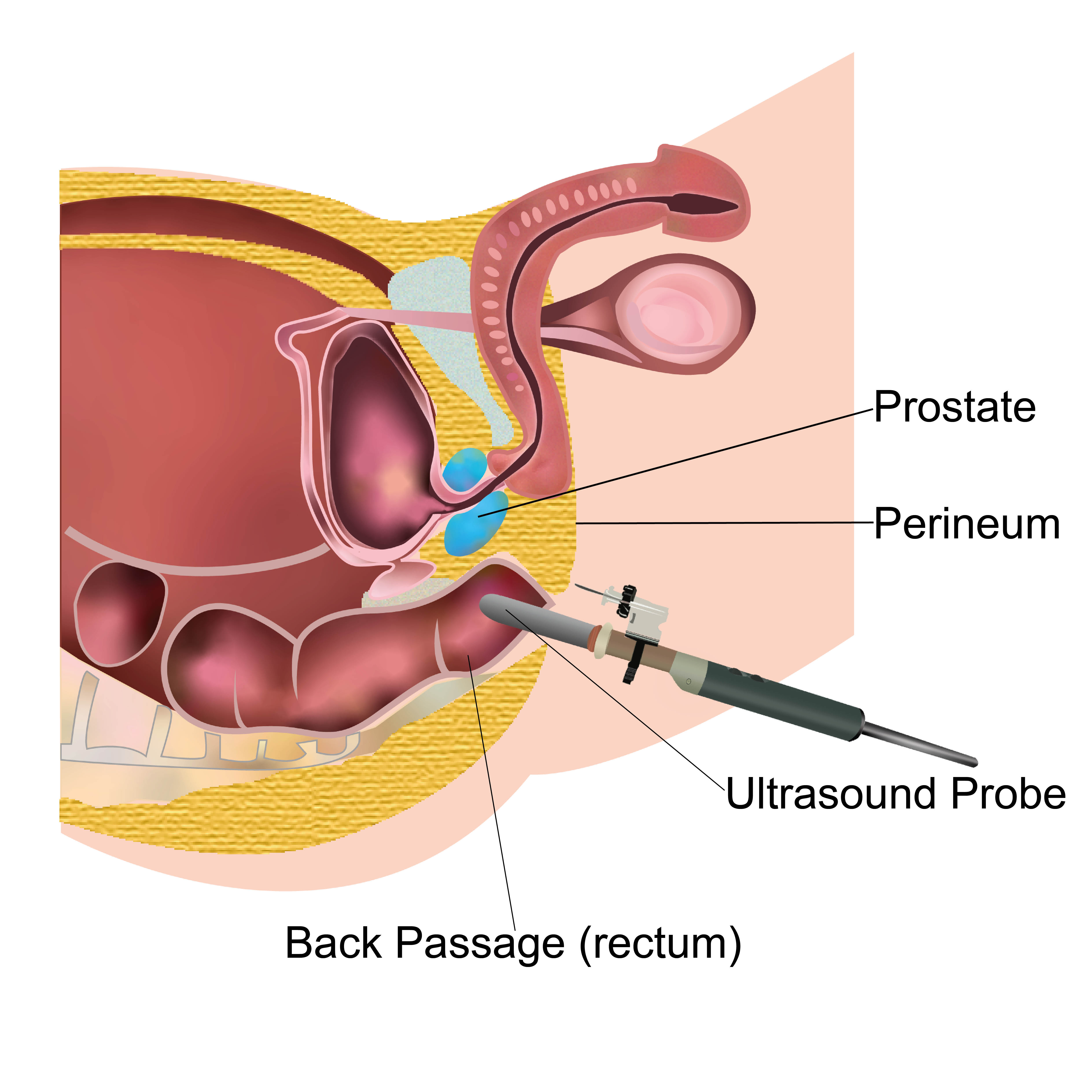 Ultrasound probe being inserted into the back passage (rectum)