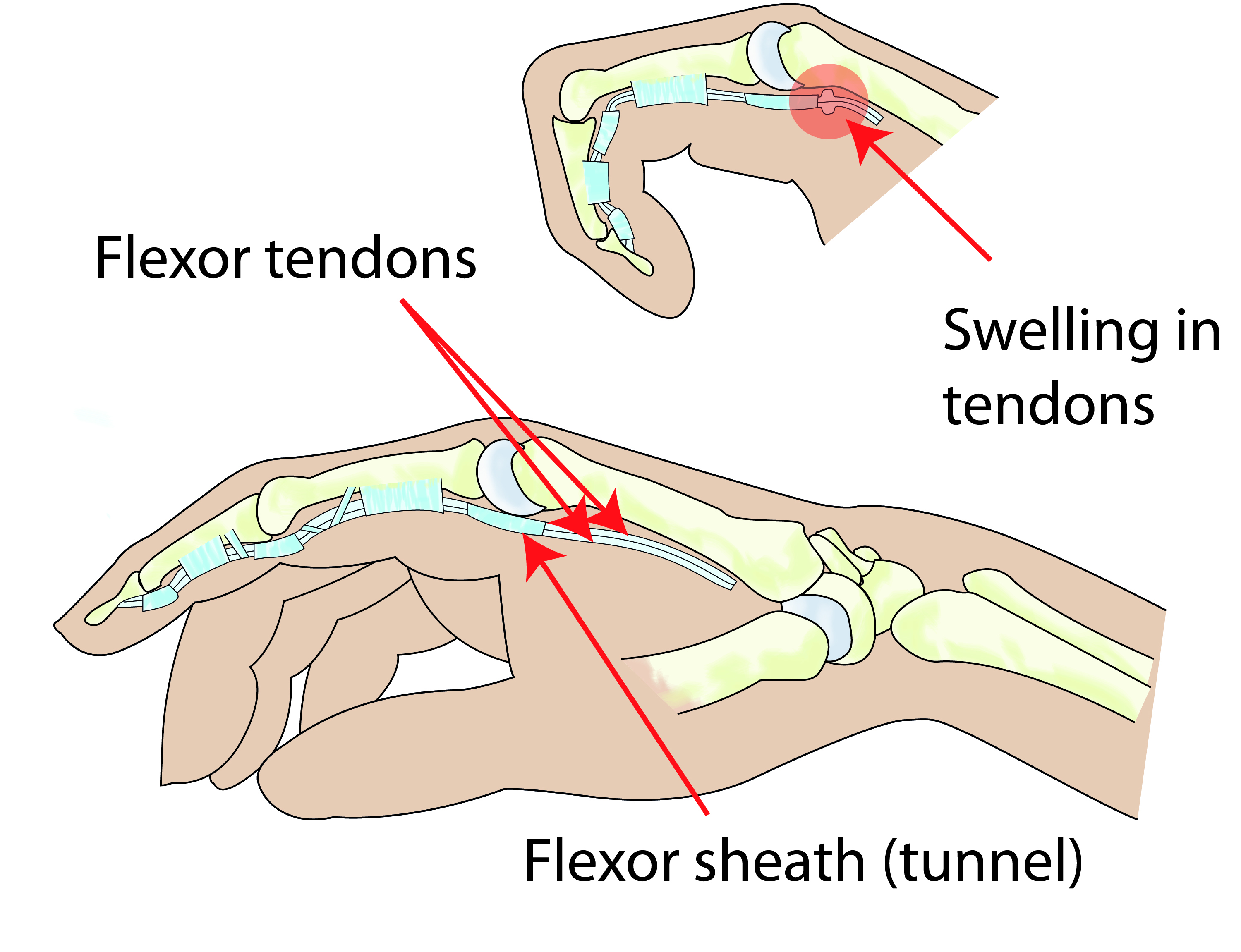 trigger-finger-medphoto.jpg