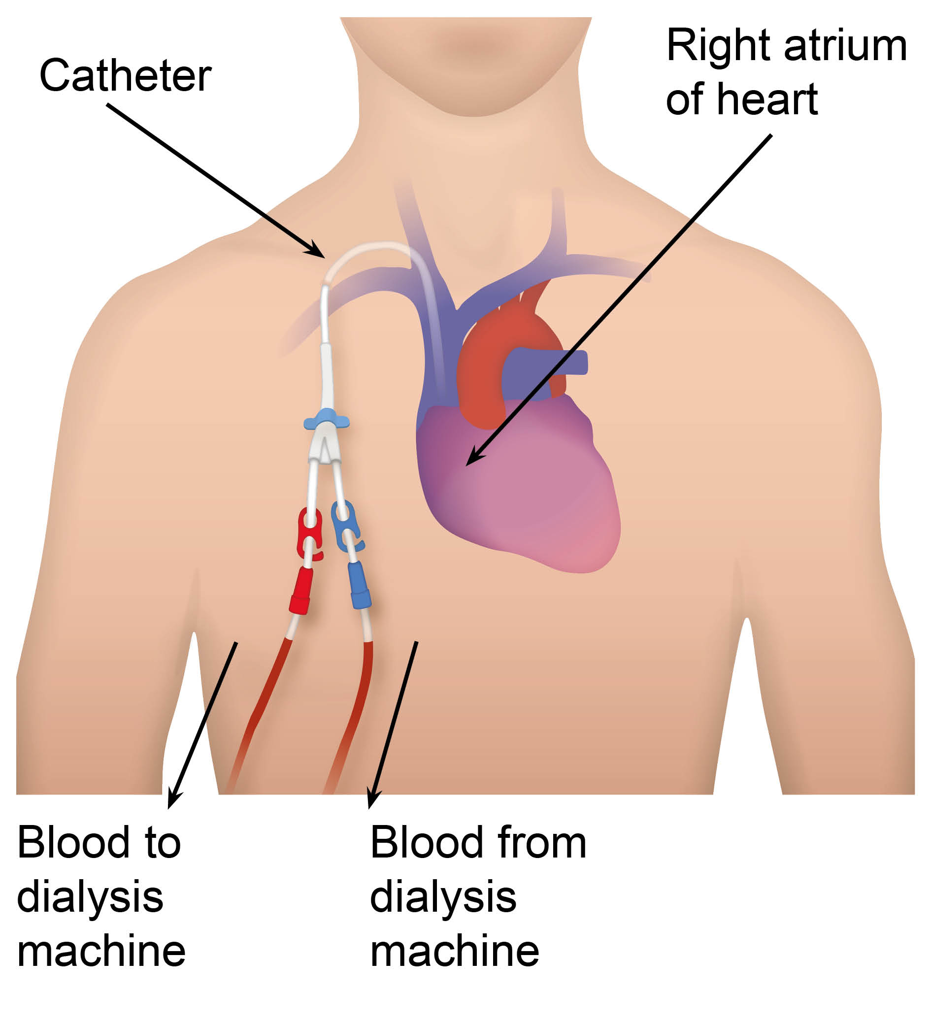 Insertion and care of a tunnelled dialysis line