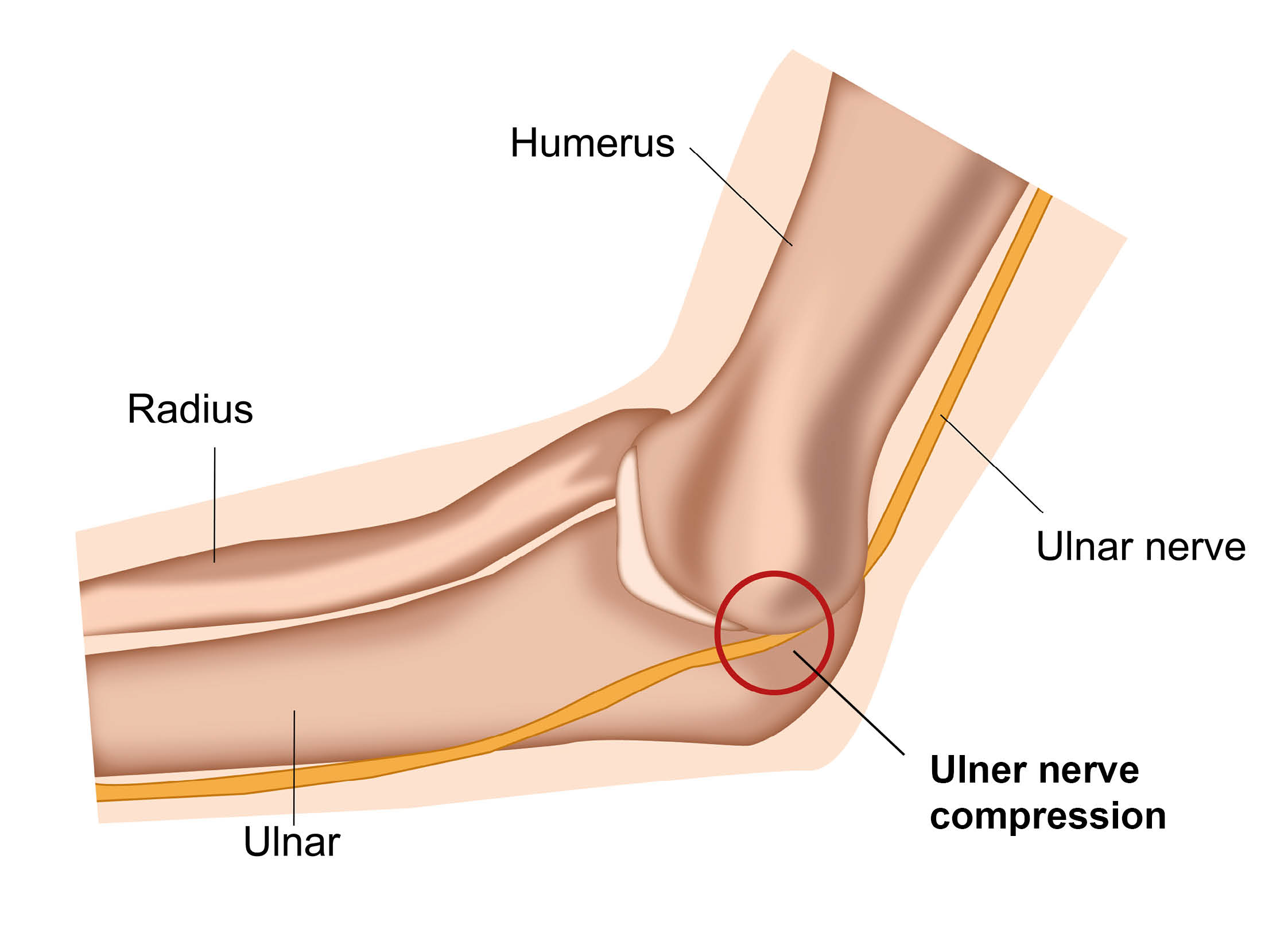 The ulner nerve being compressed between humerus and ulnar bones, on the inside of the elbow