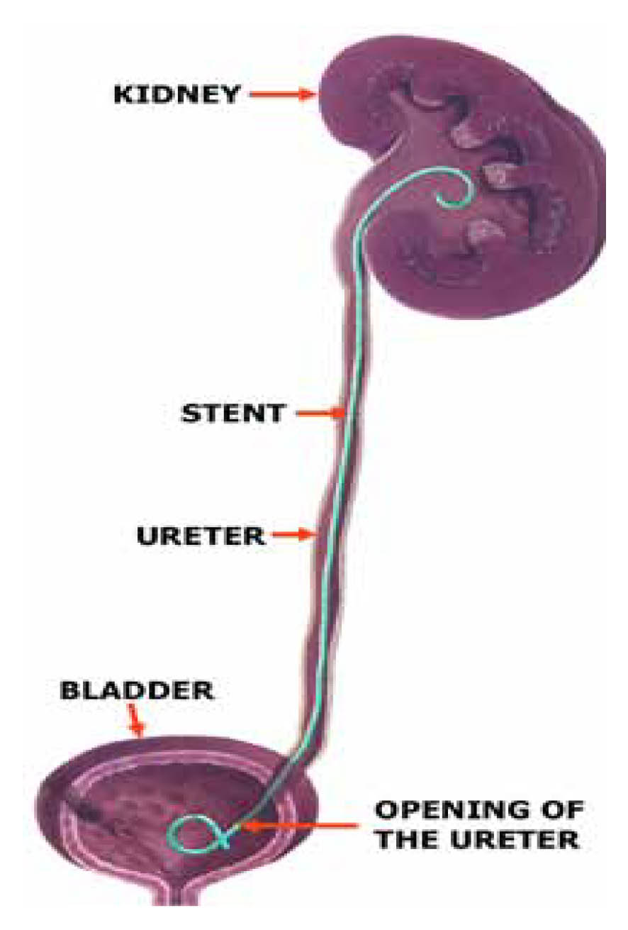 A ureteric stent allowing urine to flow from the kidney to the bladder