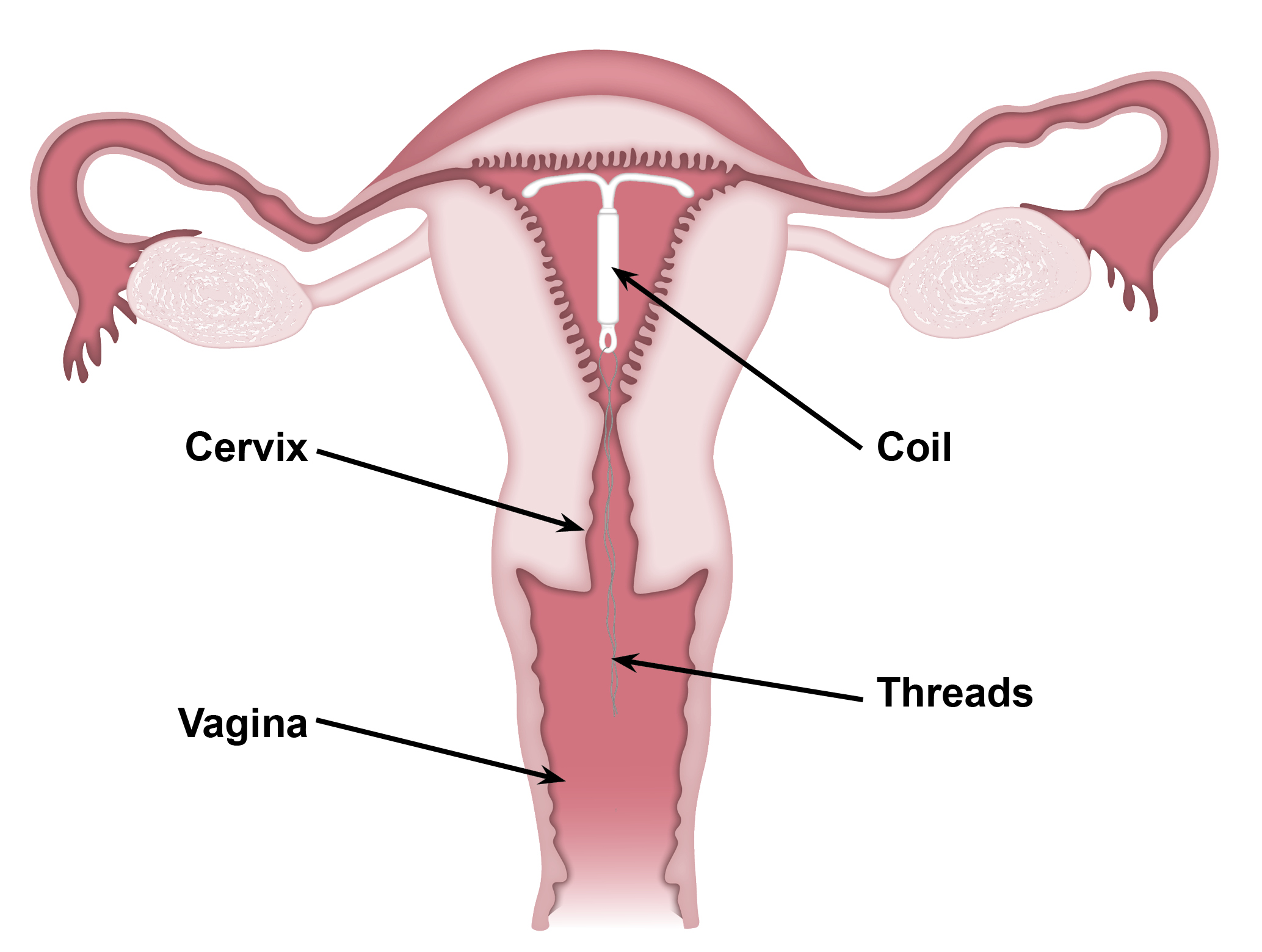 uterus-long-coil-threads.jpg