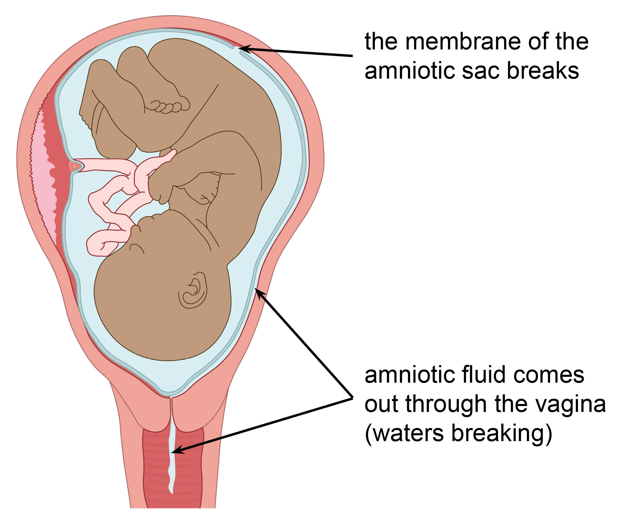 Diagram showing the membrane of the amniotic sac rupturing (breaking), and amniotic fluid coming out through the vagina (waters breaking)